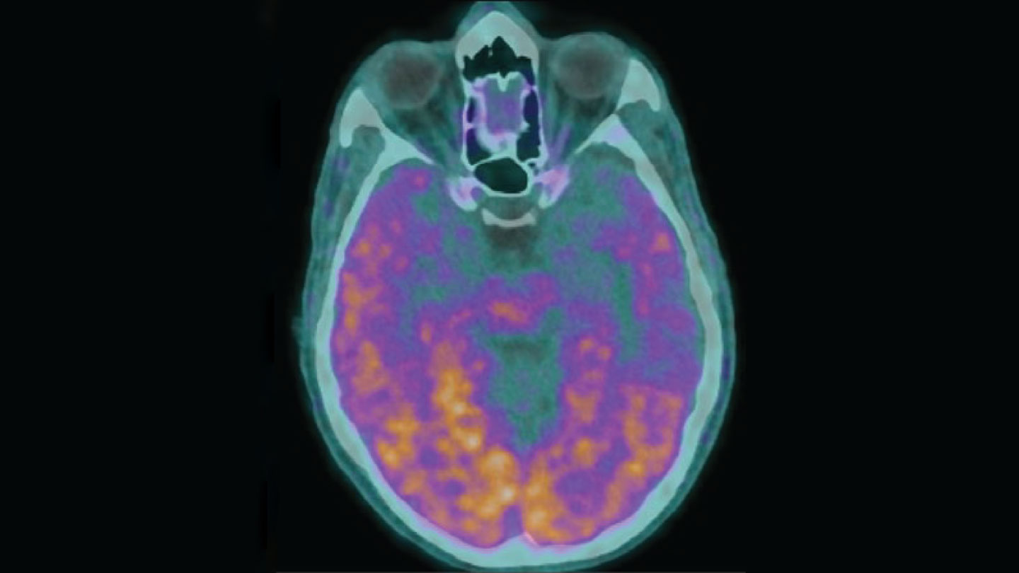 An image of a brain scan with glowing purple and orange stains marking amyloid-beeta.